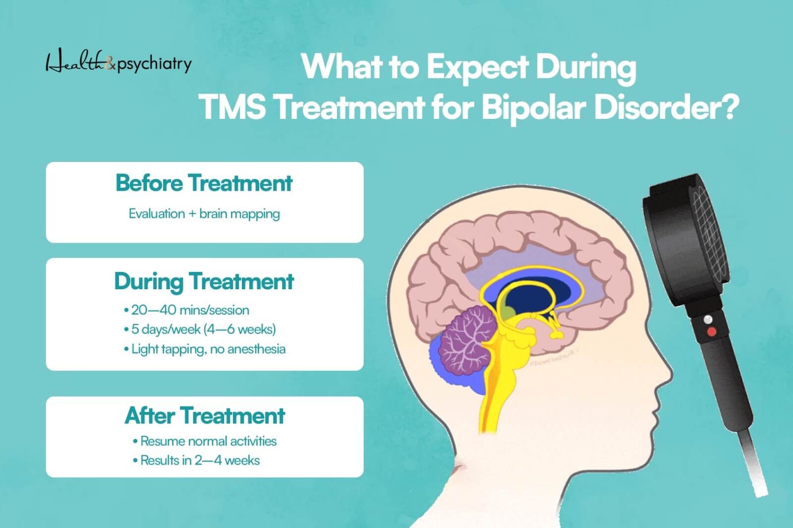 infographics about what to expect during TMS for bipolar